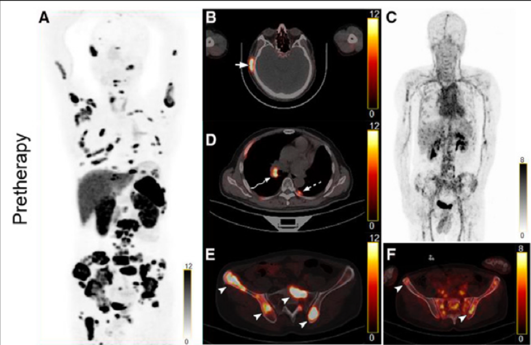 我国核医学团队成果连发国际顶刊 诊疗一体化临床应用再获突破